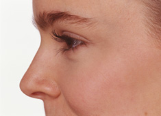 Nose Surgery (Rhinoplasty) in New York City & Manhattan