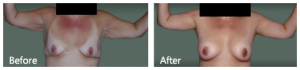 Brachioplasty after weight loss NYC