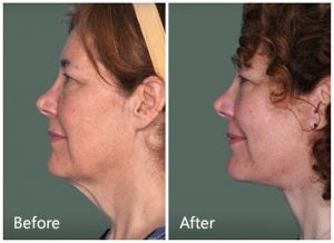 face slimming mask before and after plastic surgery