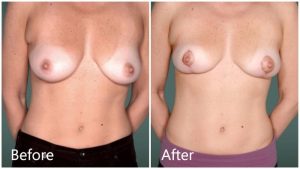 Breast lift Manhattan