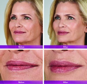 Cosmetic Injectable before & after NYC