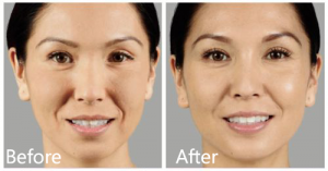 Juvederm Voluma before & after Manhattan, NYC